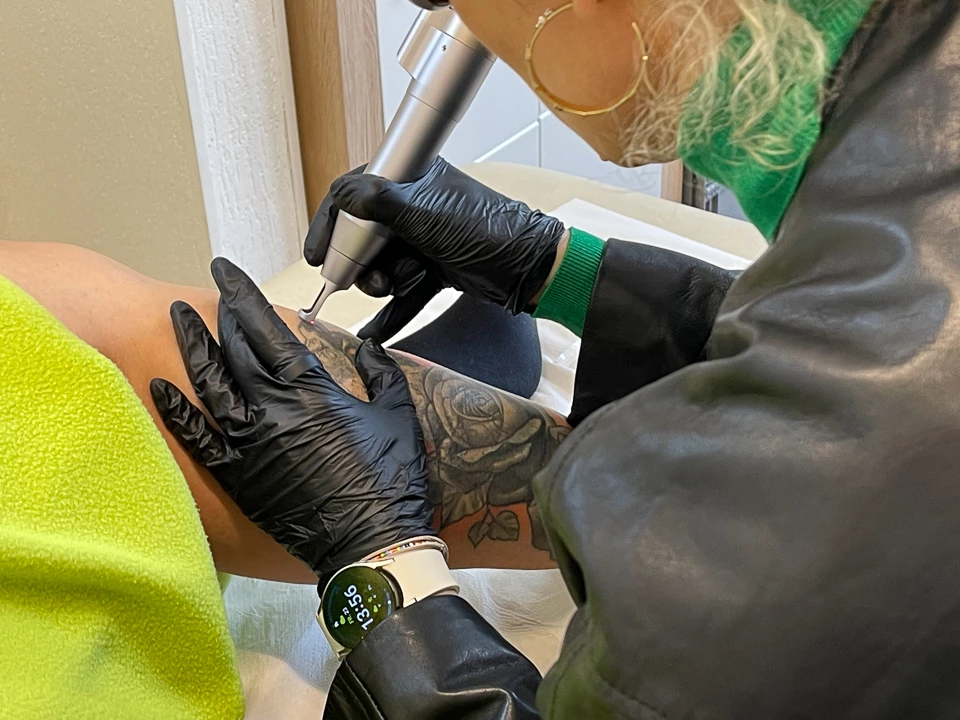 Lasertherapie zur Tattooentfernung